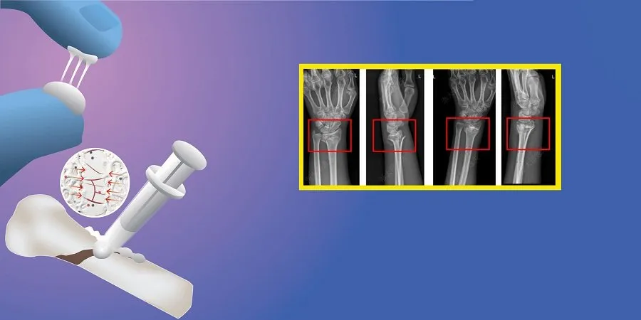 2-3 મિનિટમાં તૂટેલા હાડકાં જોડશે, ચીને બનાવ્યું વિશ્વનું પહેલું 'બૉન ગ્લુ' 3 china 1.jpg