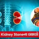 kidney stone 654