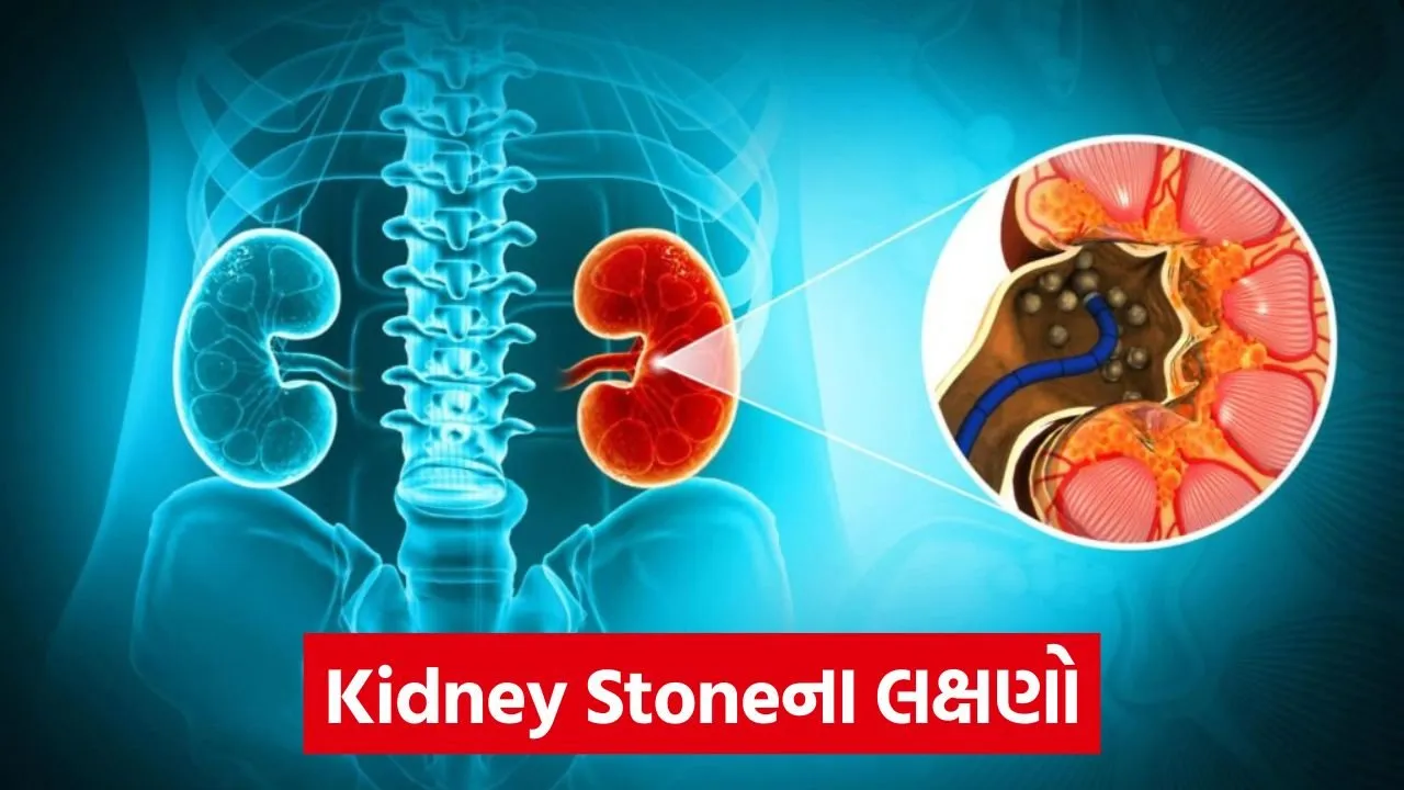 kidney stone 654.jpg