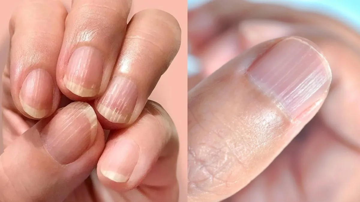 નખ તમારા સ્વાસ્થ્યનો અરીસો: આ 5 સંકેતો ઓળખો 3 Nail.jpg