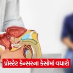 Prostate Cancer