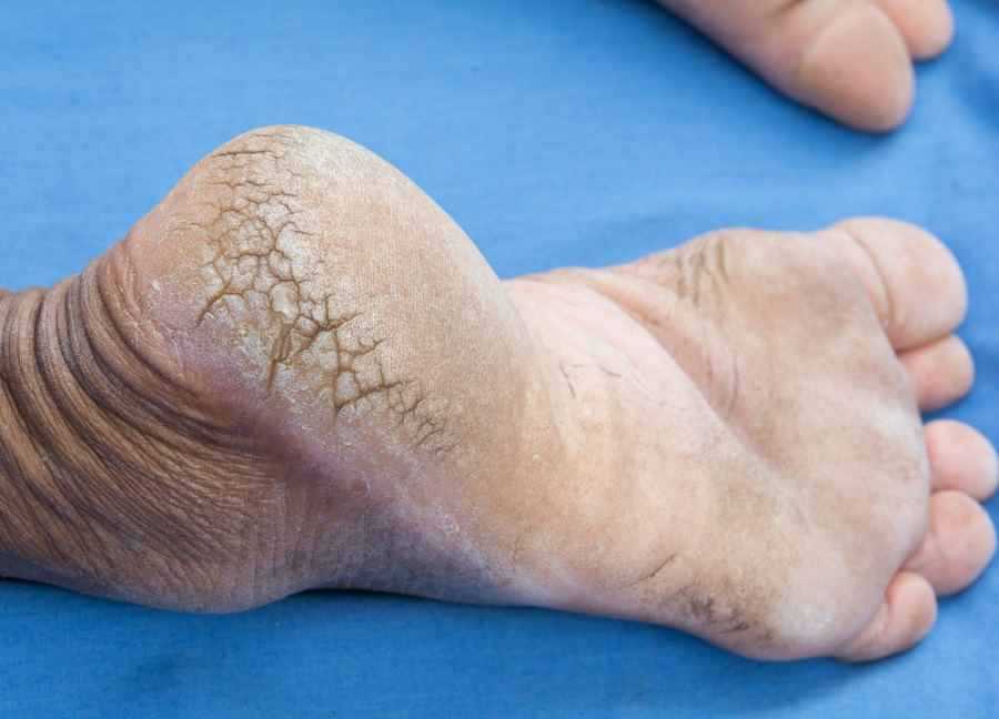 ફાટેલી એડીઓ માત્ર ડ્રાયનેસ નહીં! શરીરમાં કયા વિટામિનની ઊણપ છે? ડોક્ટરે આપ્યો ખુલાસો 2 heel