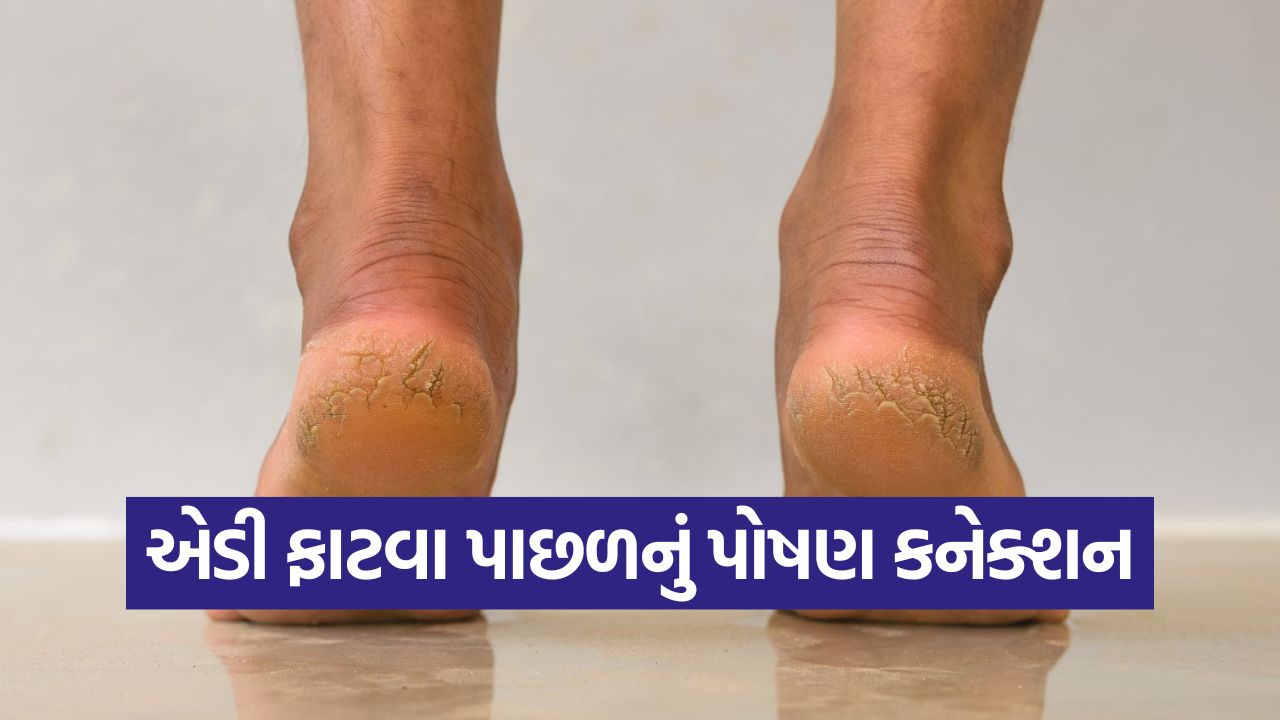 ફાટેલી એડીઓ માત્ર ડ્રાયનેસ નહીં! શરીરમાં કયા વિટામિનની ઊણપ છે? ડોક્ટરે આપ્યો ખુલાસો 23 heel2