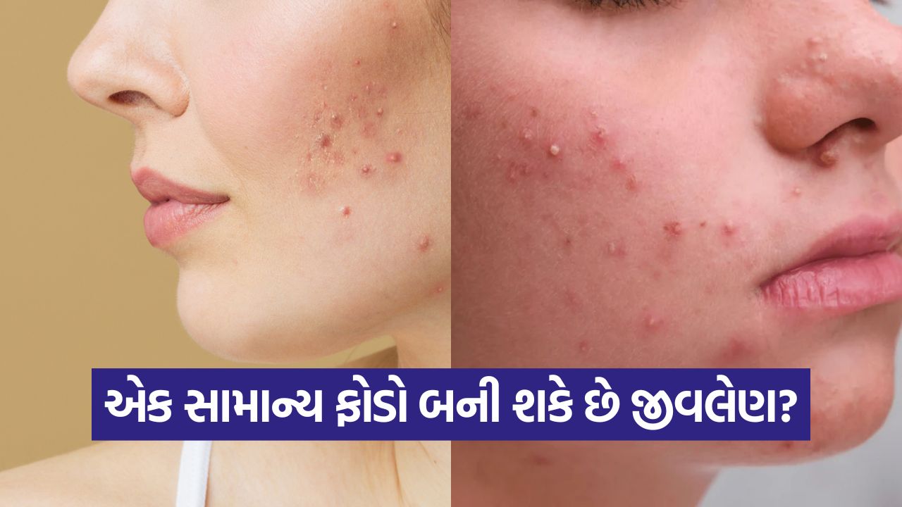સામાન્ય સ્કીન ઇન્ફેક્શન પણ ગંભીર બની શકે: શું ફોલ્લાને દબાવવાથી મૃત્યુ થઈ શકે? 25 skin 45
