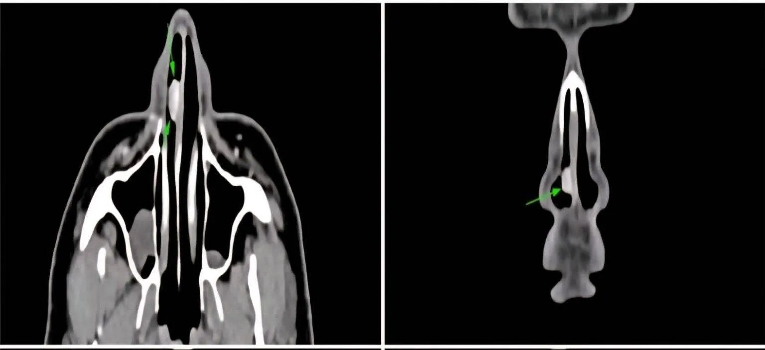 રાજકોટના ENT સર્જન ડૉ. હિમાંશુ ઠક્કરની દુર્લભ સર્જિકલ સિદ્ધિ, નાકના પડદામાં જોવા મળેલી અનોખી લોહીની ગાંઠ સફળતાપૂર્વક દૂર 3 Rare Nasal Anastomosing Hemangioma Case 1.png