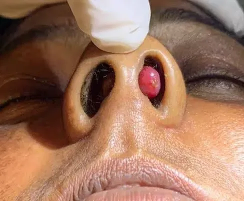 રાજકોટના ENT સર્જન ડૉ. હિમાંશુ ઠક્કરની દુર્લભ સર્જિકલ સિદ્ધિ, નાકના પડદામાં જોવા મળેલી અનોખી લોહીની ગાંઠ સફળતાપૂર્વક દૂર 2 Rare Nasal Anastomosing Hemangioma Case 2.png