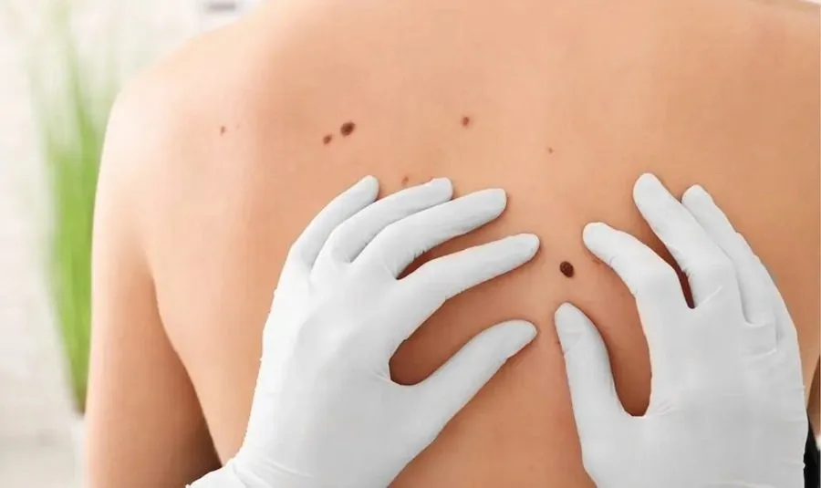 સ્કિન કેન્સર: જોખમ કોને વધુ? ડૉક્ટર પાસેથી જાણો મુખ્ય લક્ષણો અને તેનાથી બચવાના ઉપાયો 2 skin cancer.jpg