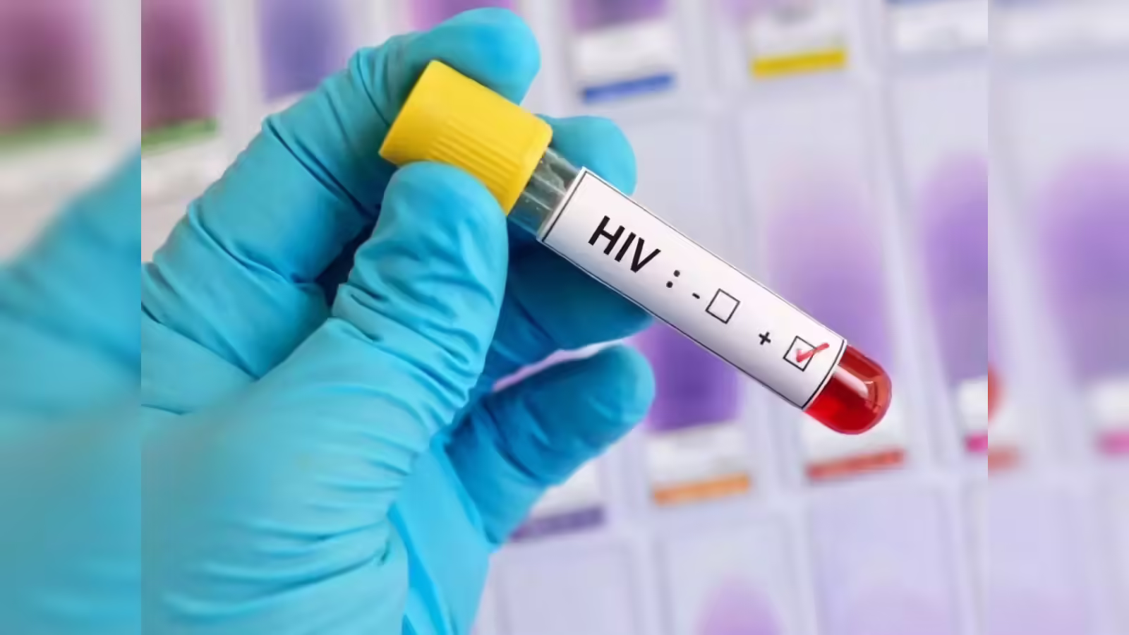 આંધ્ર પ્રદેશમાં "AIDS" કેસો વધ્યા, આરોગ્ય મંત્રીએ એલર્ટ આપ્યું 2 aids1