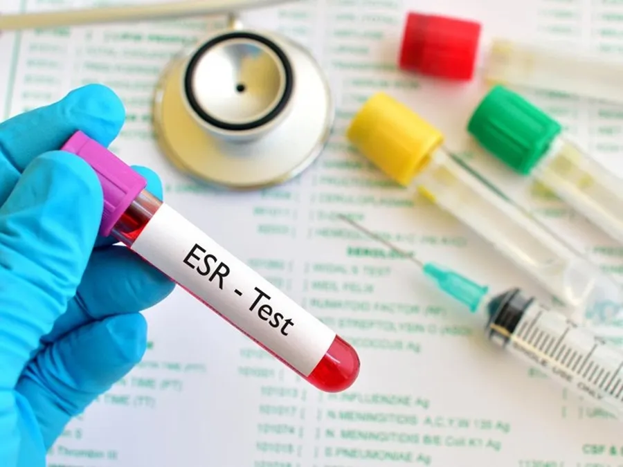 ESR ટેસ્ટ શું છે? જાણો આ સામાન્ય બ્લડ ટેસ્ટ વધે કે ઘટે તો કયા રોગનો સંકેત આપે છે! 2 ESR.jpg