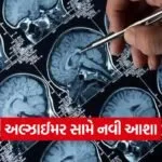 alzheimer nanoparticle therapy 1