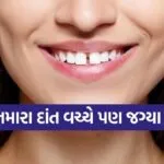 Tooth Gap