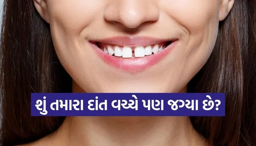 Tooth Gap