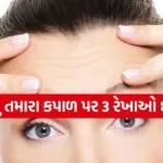 Forehead Lines