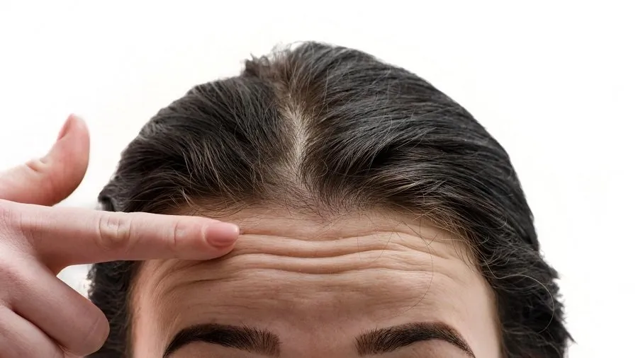 Forehead Lines