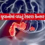 rectal cancer 0305