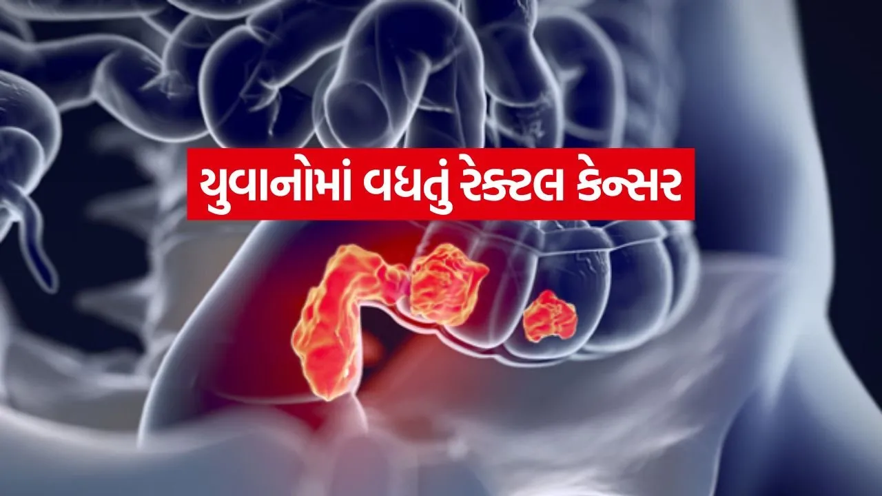 rectal cancer 0305.jpg