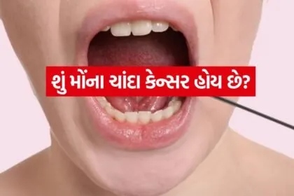 Oral cancer 2606