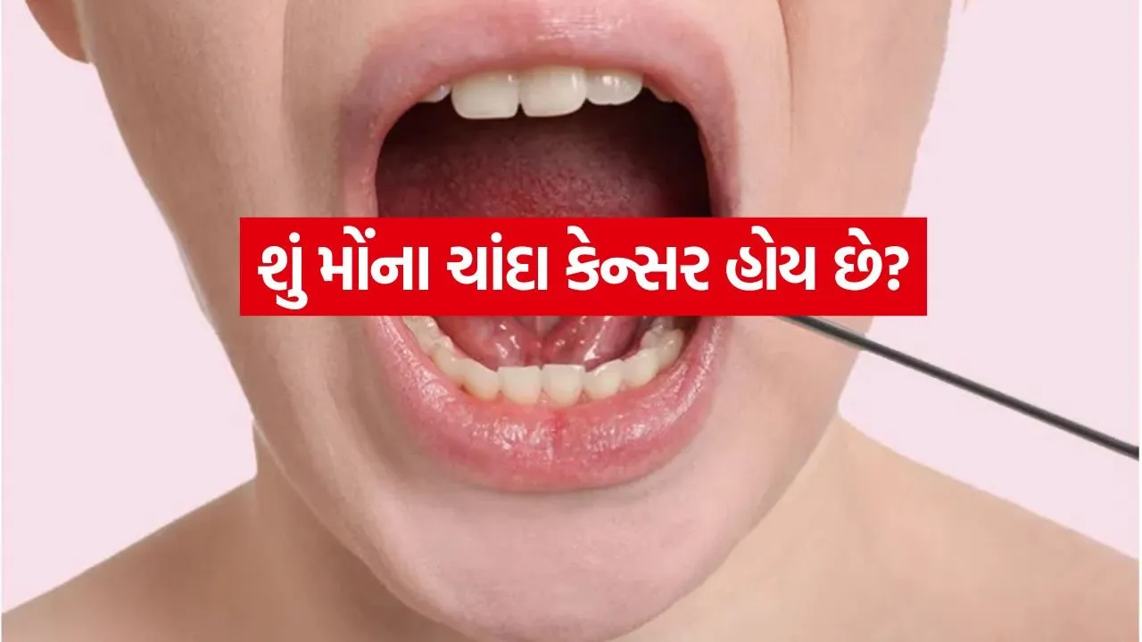 Oral cancer 2606.jpg