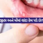 Mouth Ulcers