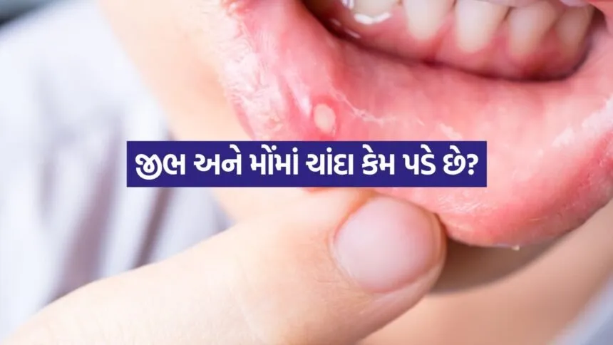 Mouth Ulcers