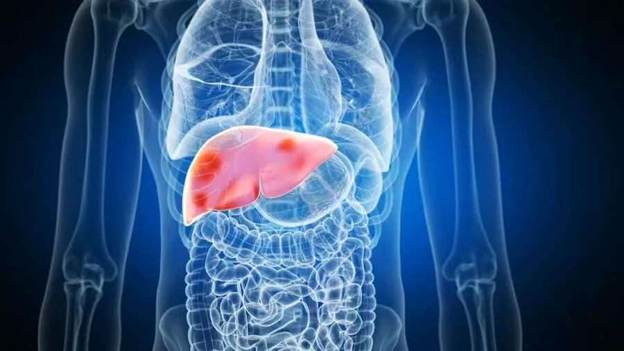 Fatty liver1.jpg