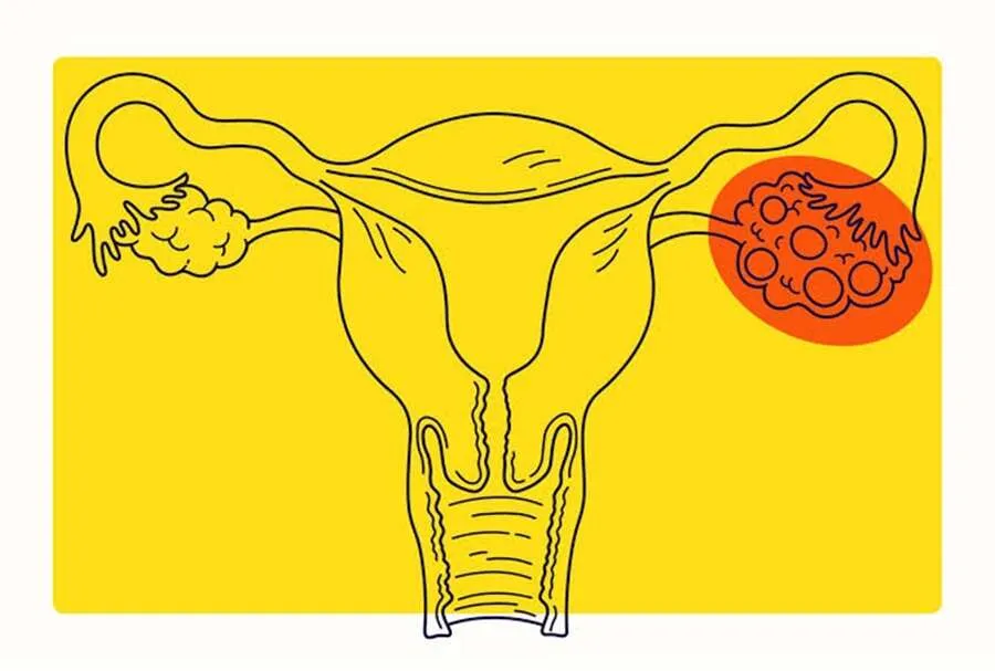 વજન સામાન્ય છતાં PCOS ના લક્ષણો? જાણો 'લીન પીસીઓએસ' શું છે અને તેને કેવી રીતે ઓળખવું 3 pocs.jpg